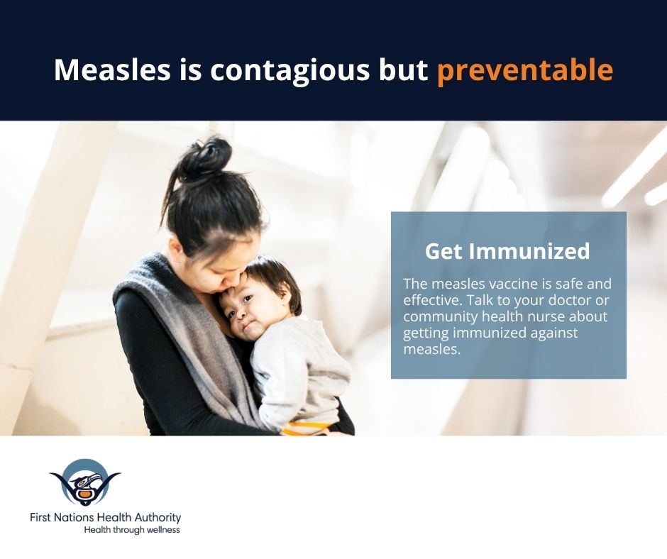 The importance of measles vaccination